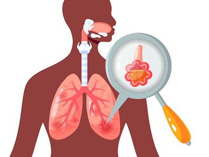 Kenali Penyebab Dan Tanda-Tanda Pneumonia, Biar Terhindar Dari Bahayanya